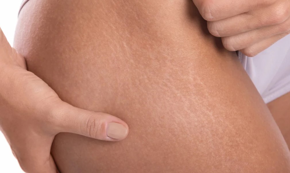 Apa-Itu-Stretch-Mark-dan-Mengapa-Perlu-Dihilangkan