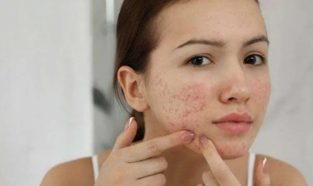 Cara-Memilih-Produk-Perawatan-Jerawat