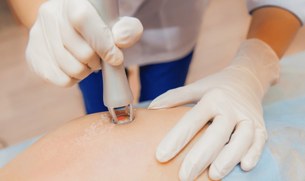 Keuntungan-Teknologi-Modern-dalam-Penghilangan-Stretch-Mark