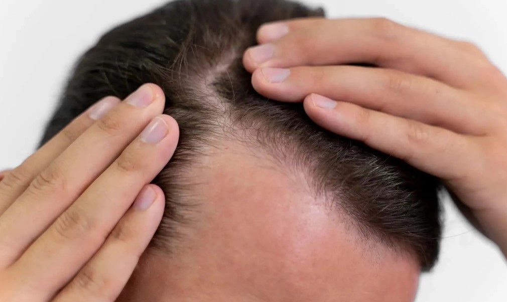 Penyebab-Rambut-Rontok-dan-Mengapa-Anda-Perlu-Mengatasinya