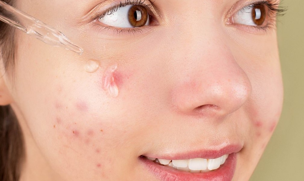 Rekomendasi-Produk-Perawatan-Jerawat-Terbaik