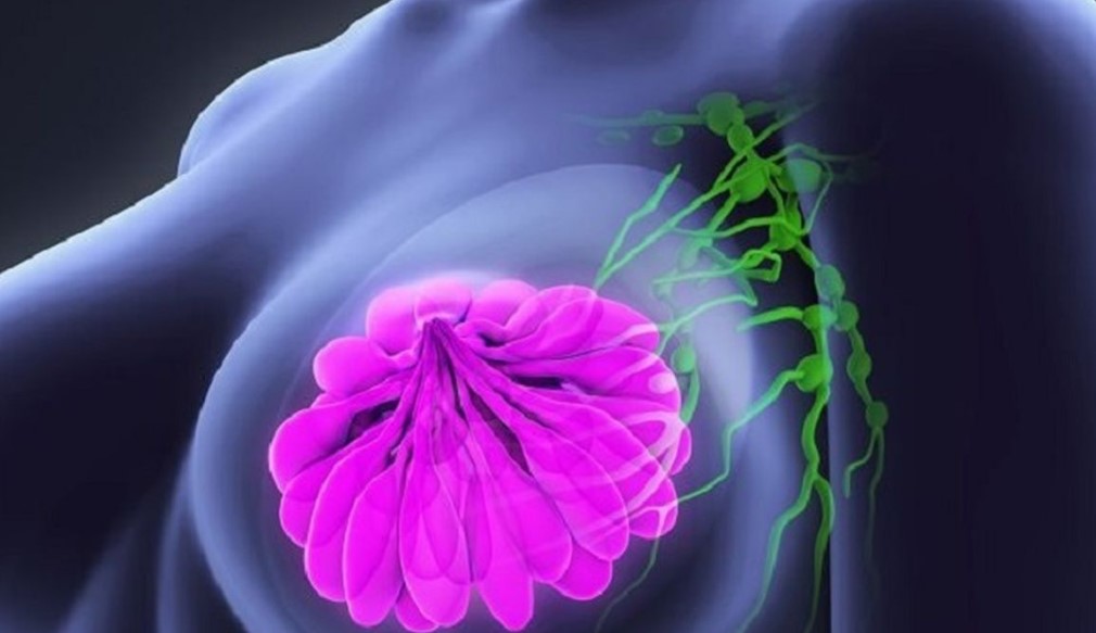 Rekomendasi-Produk-Perawatan-Kanker-Payudara