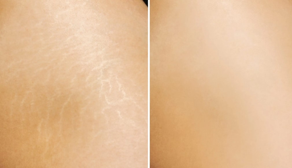 penghilangan-stretch-mark