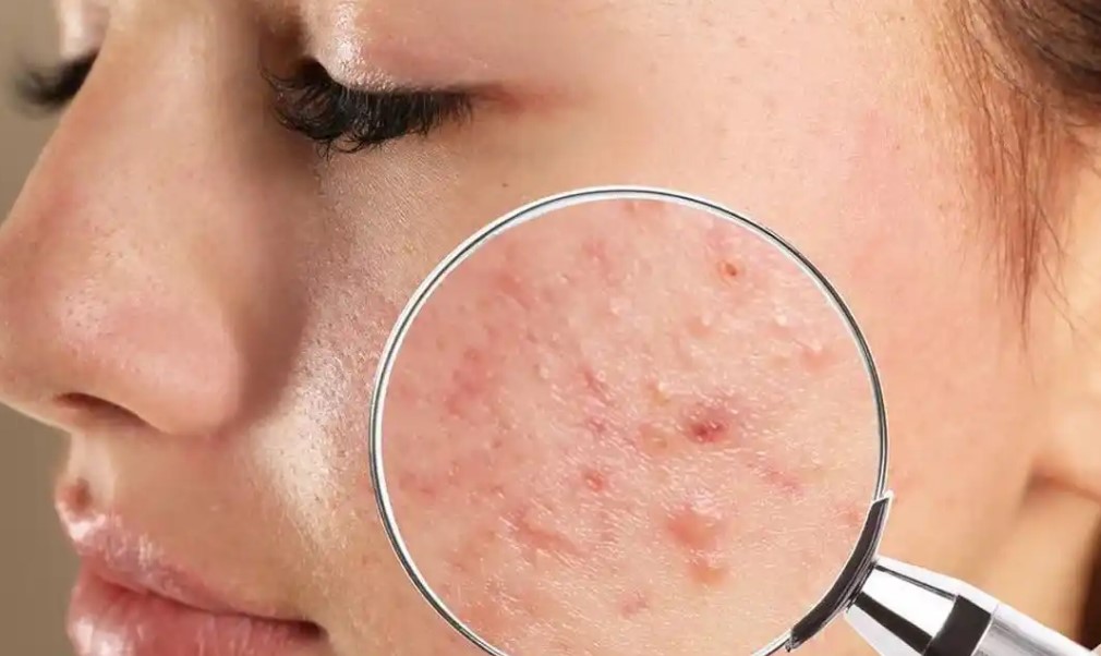 perawatan-jerawat