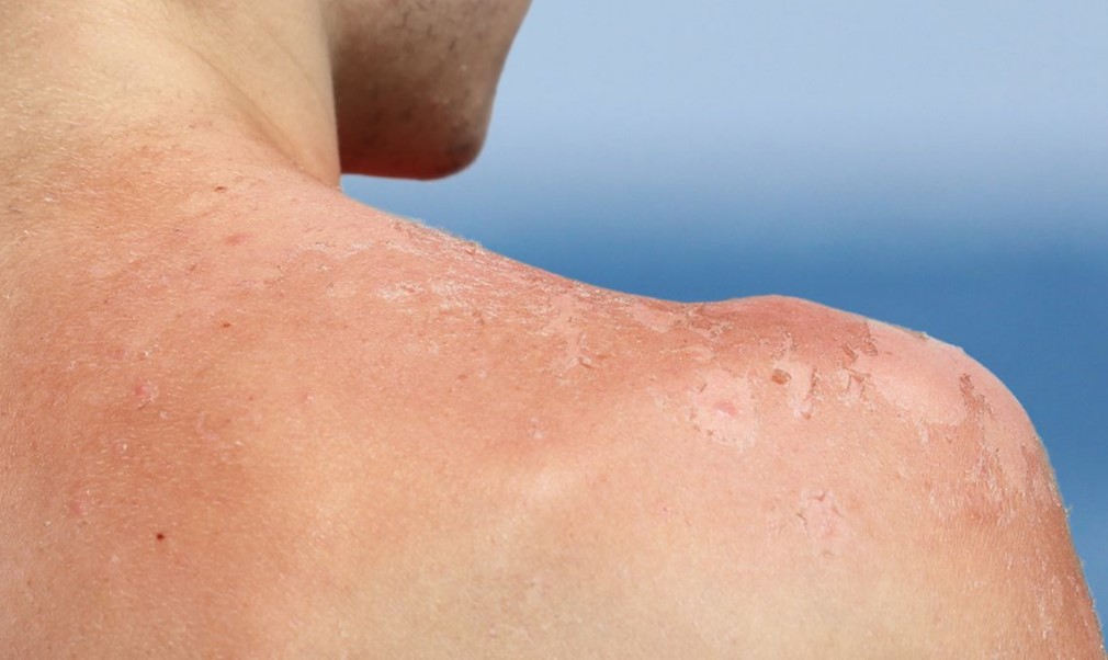 tips-mencegah-kulit-terbakar-saat-berwisata